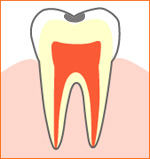 caries01.jpg