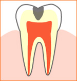 caries01.jpg