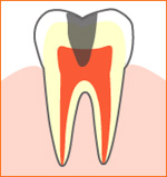 caries01.jpg